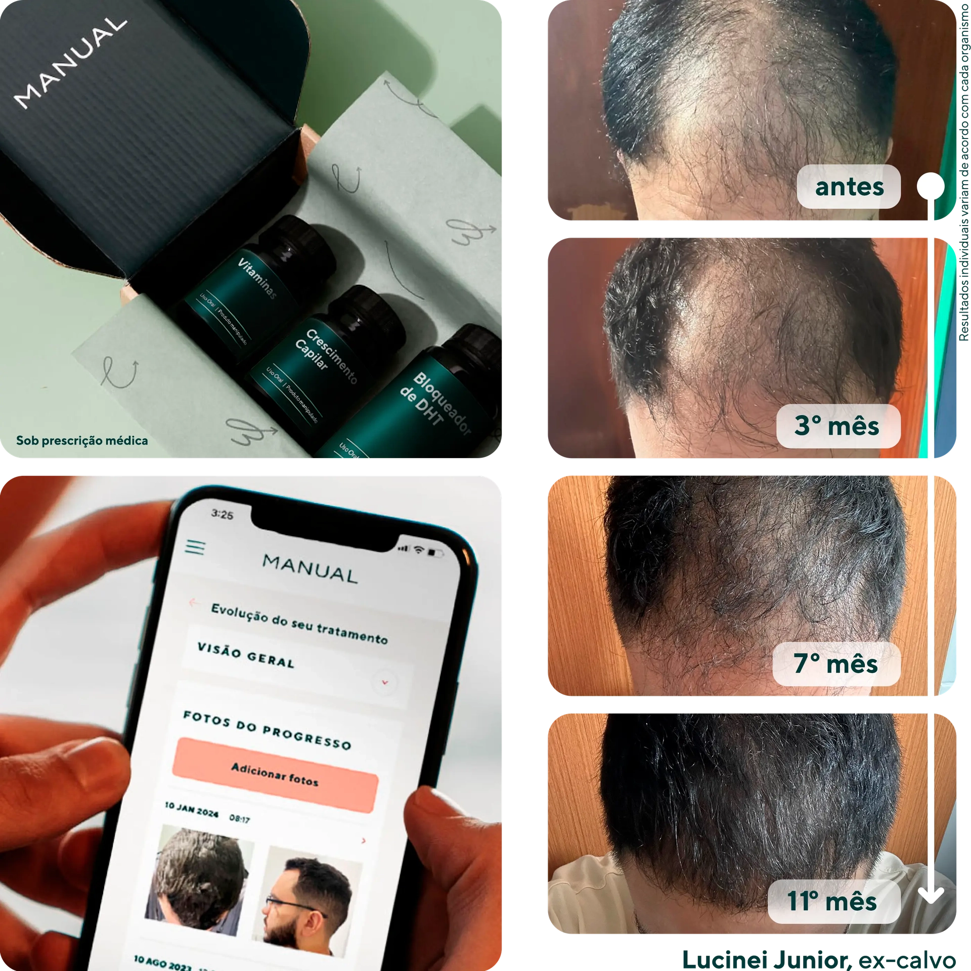 Resultados do tratamento Manual - Progressão de antes, 3 meses, 7 meses e 11 meses mostrando recuperação capilar